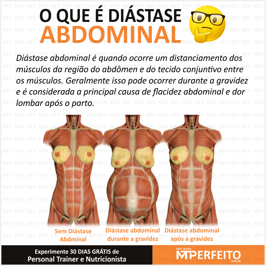 O que é Diástase Abdominal?